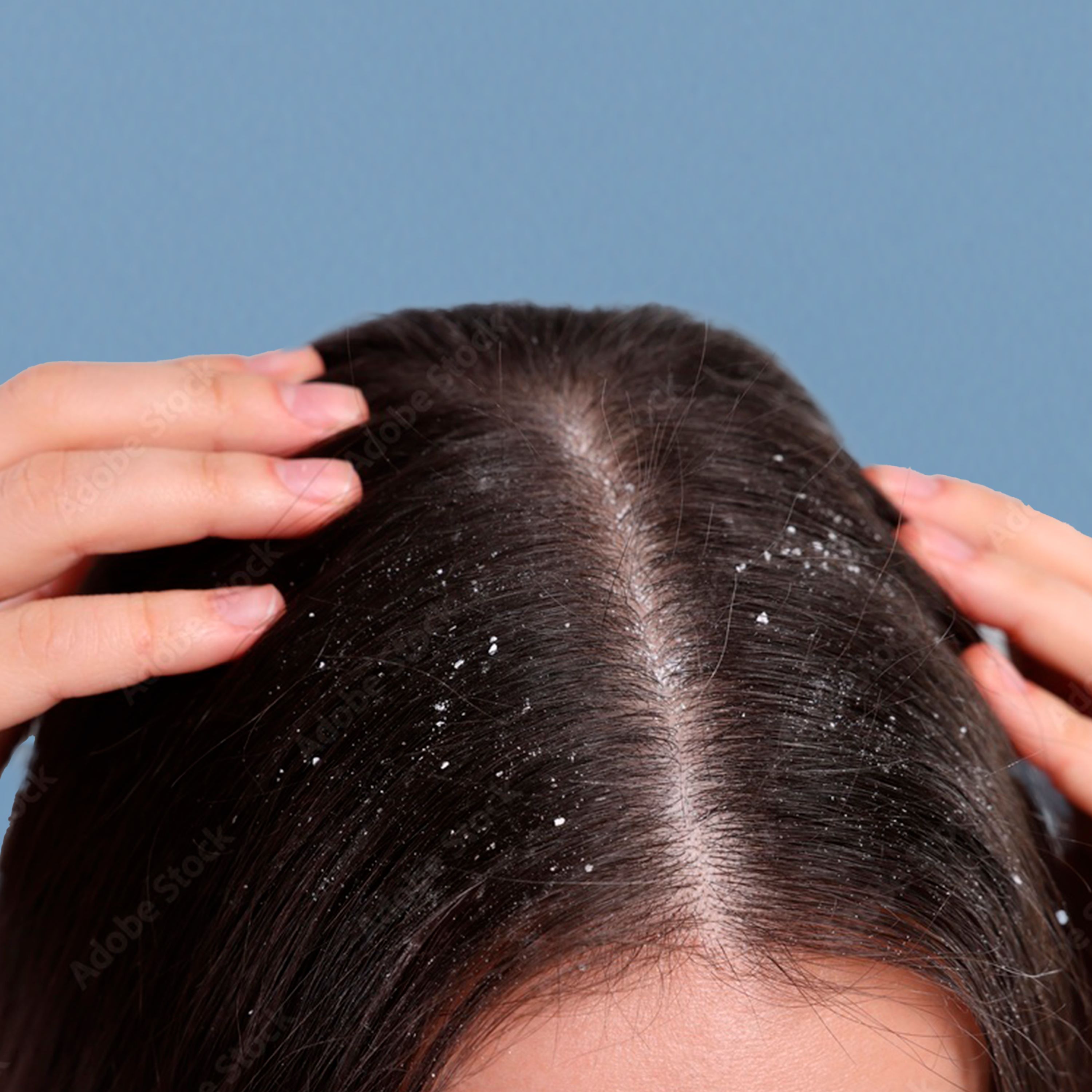 Ducray Kelual Squanorm Dry Dandruff Shampoo