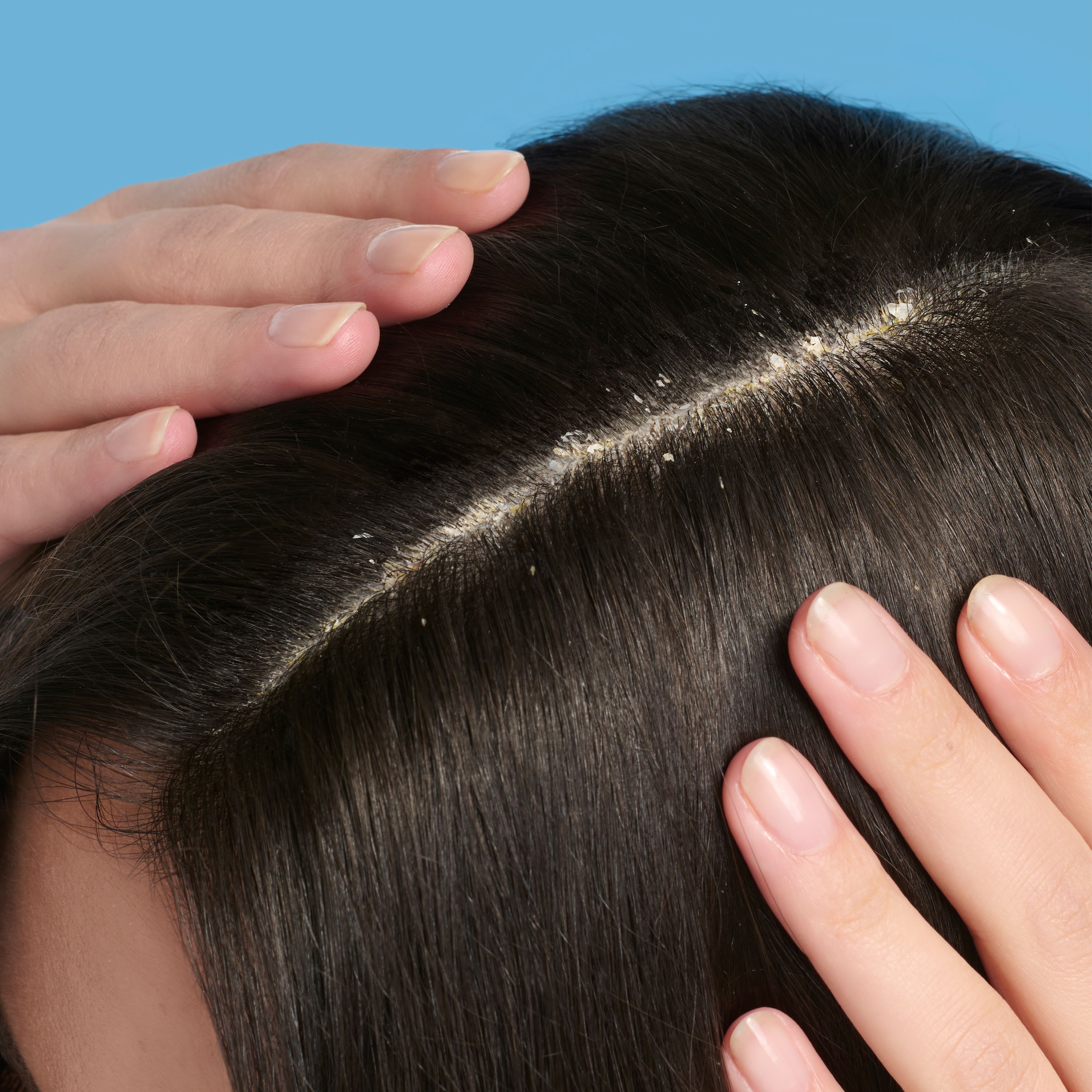 Ducray Kelual Squanorm Oily Dandruff Shampoo